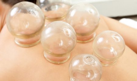 Cupping Therapy