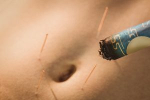 acupuncture-treatment-in-therapy-roomR